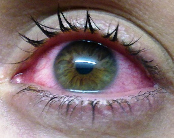 Most Effective Home Remedies To Treat Sore Eyes