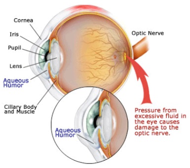 glaucoma