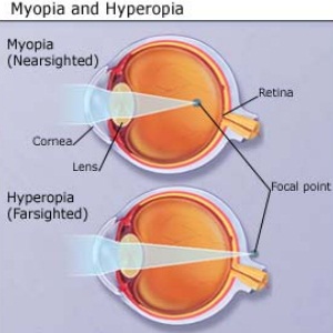 Myopia