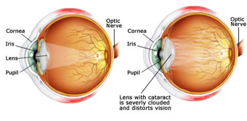 cataracts