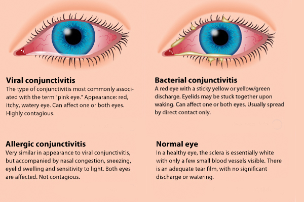 conjunctivitis or pink eye