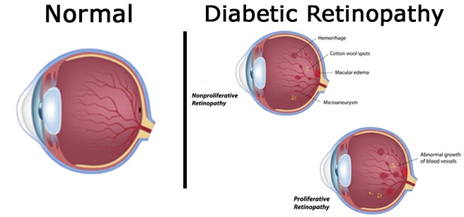 Diabetic Retinopathy