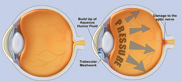 glaucoma