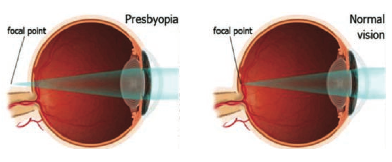 presbyopia