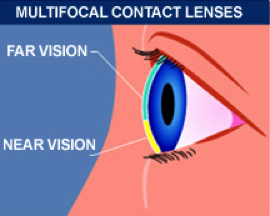 Multifocal-contact-lenses