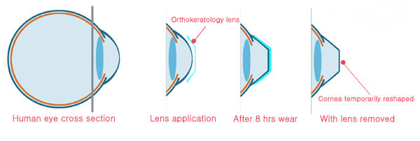 Orthokeratology shaping lenses