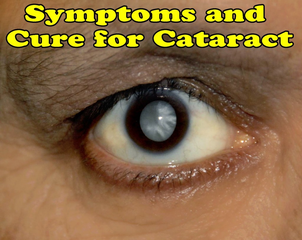 Cataracts