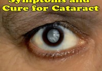 Cataracts