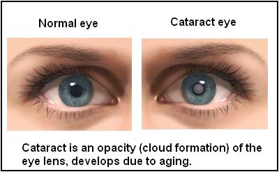 Cataracts Symptoms