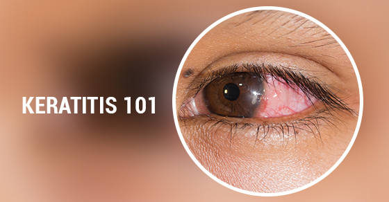 Symptoms of Keratitis