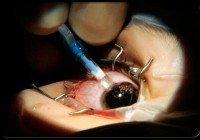 Lasik eye surgery