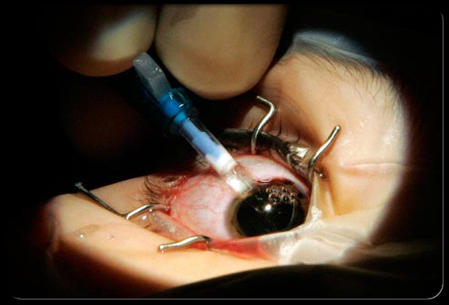 Lasik eye surgery