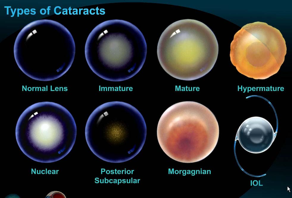 types of cataracts