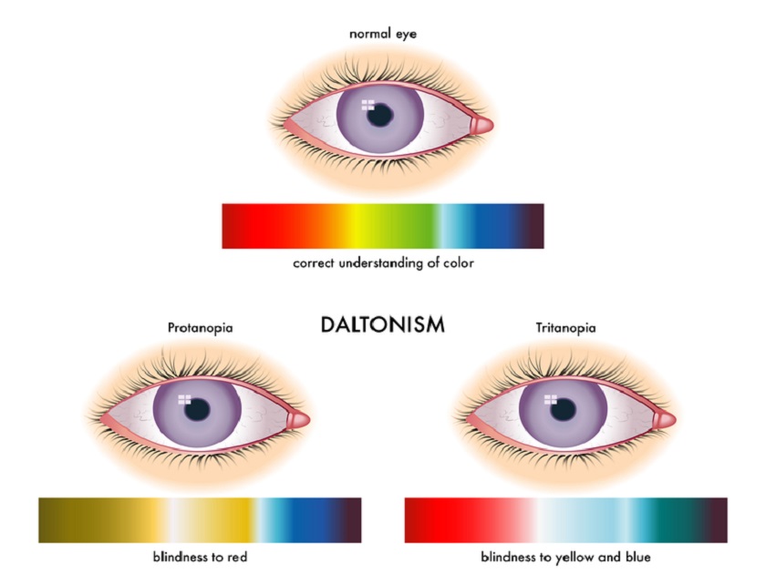 color-blindness- symptoms