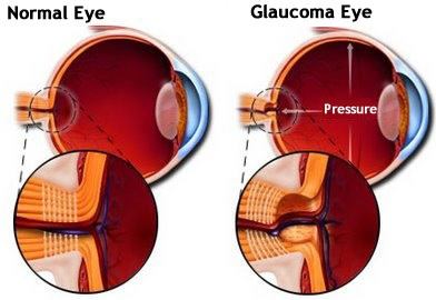 chronic glaucoma